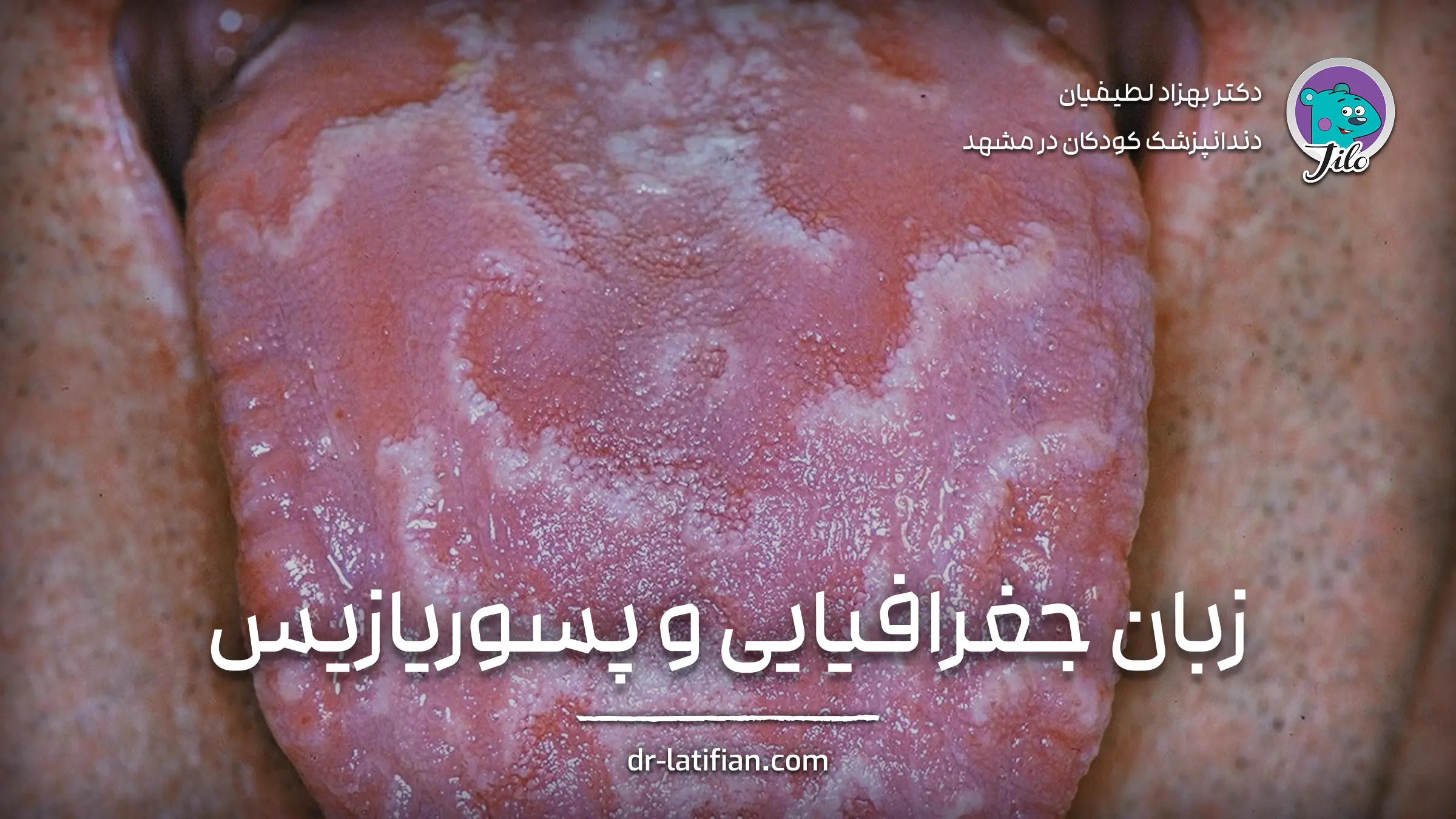 زبان جغرافیایی و پسوریازیس