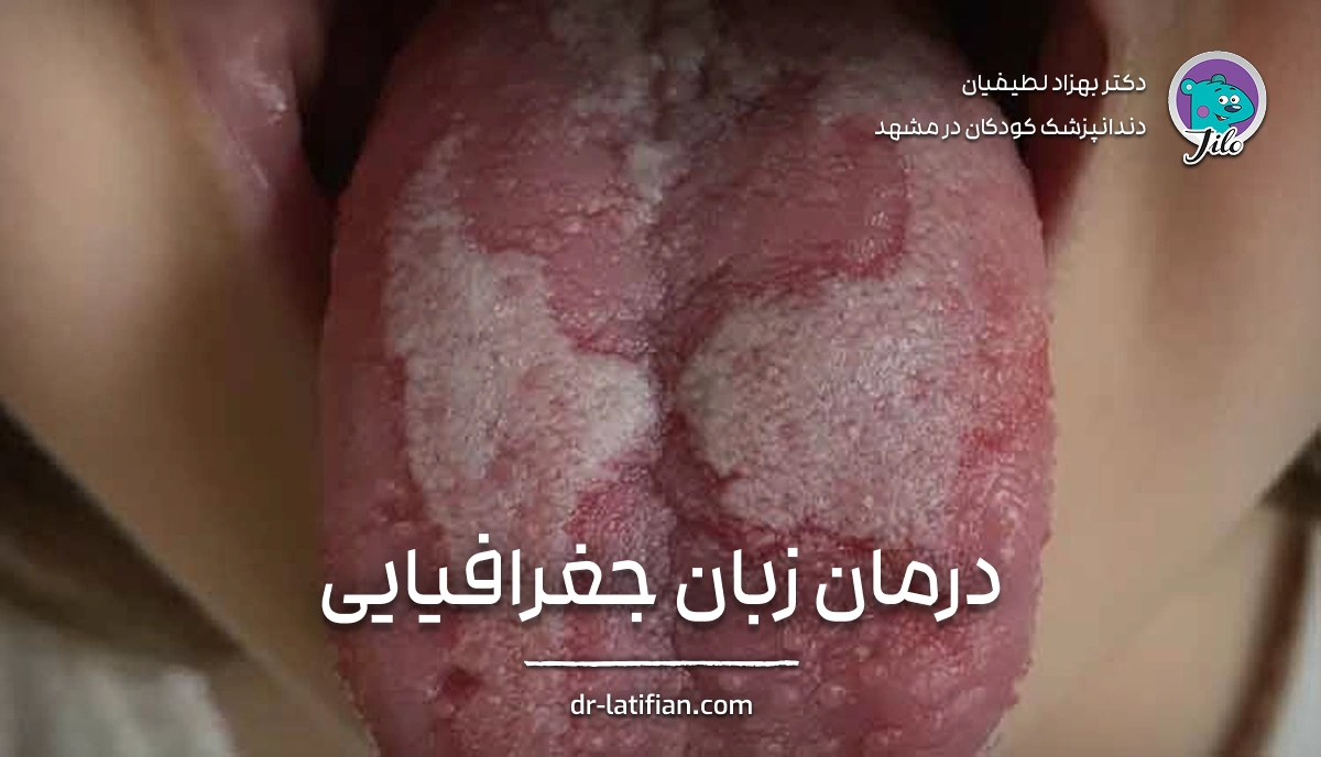 درمان زبان جغرافیایی