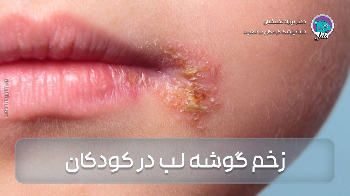 زخم گوشه لب در کودکان و نوزادان