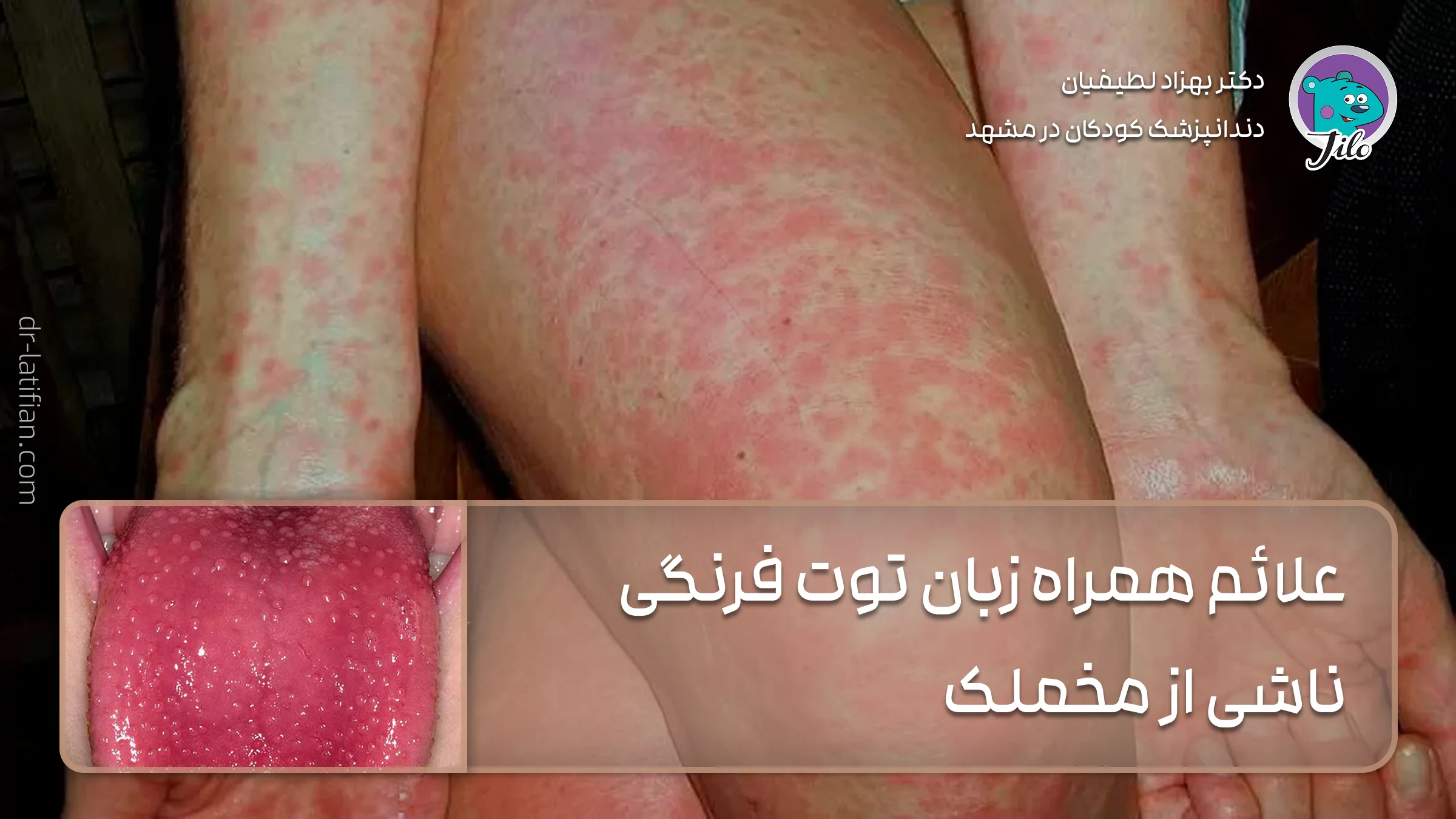 نشانه های همراه با زبان توت فرنگی