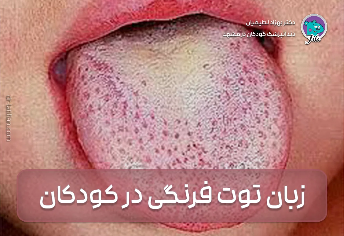 زبان توت فرنگی در کودکان