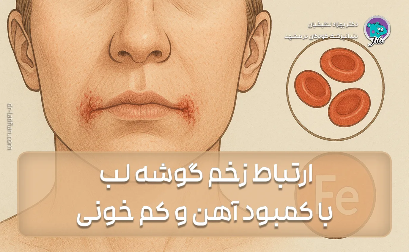 ارتباط زخم گوشه لب با کمبود آهن و کم خونی