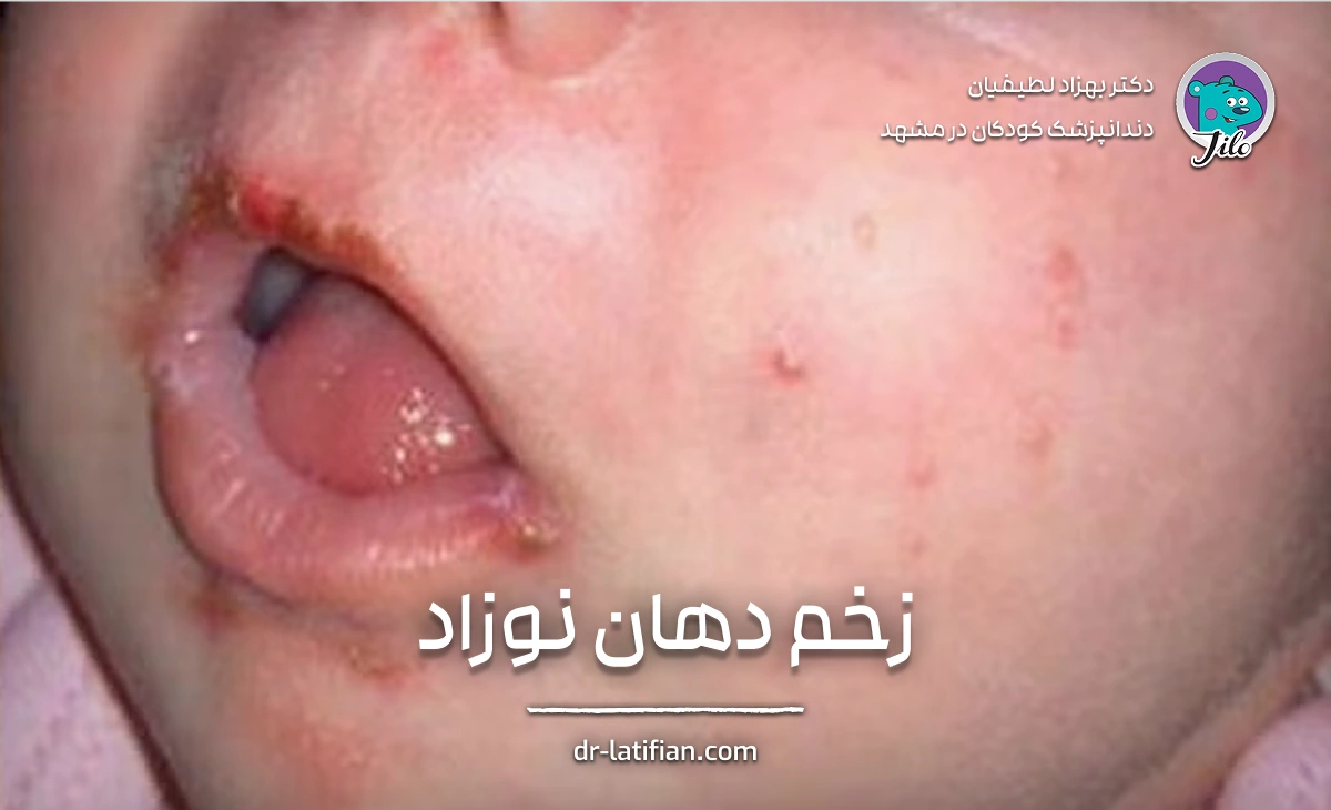 انواع زخم دهان در نوزادان و علت آن