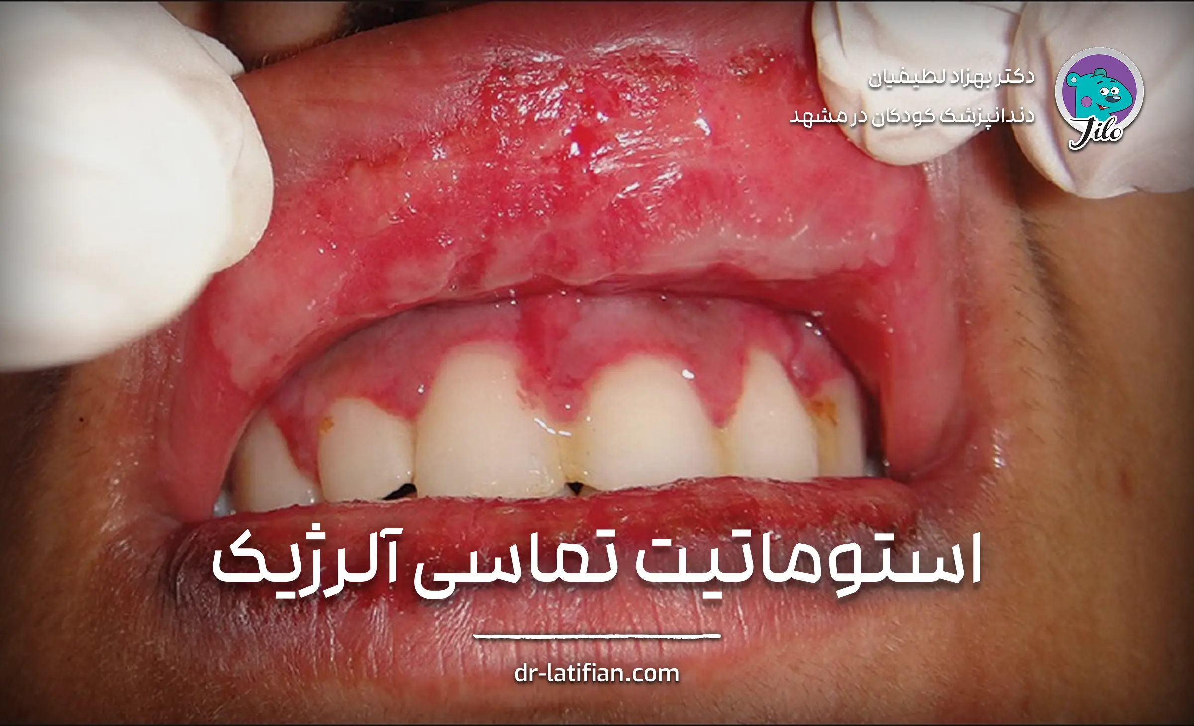 استوماتیت تماسی آلرژیک