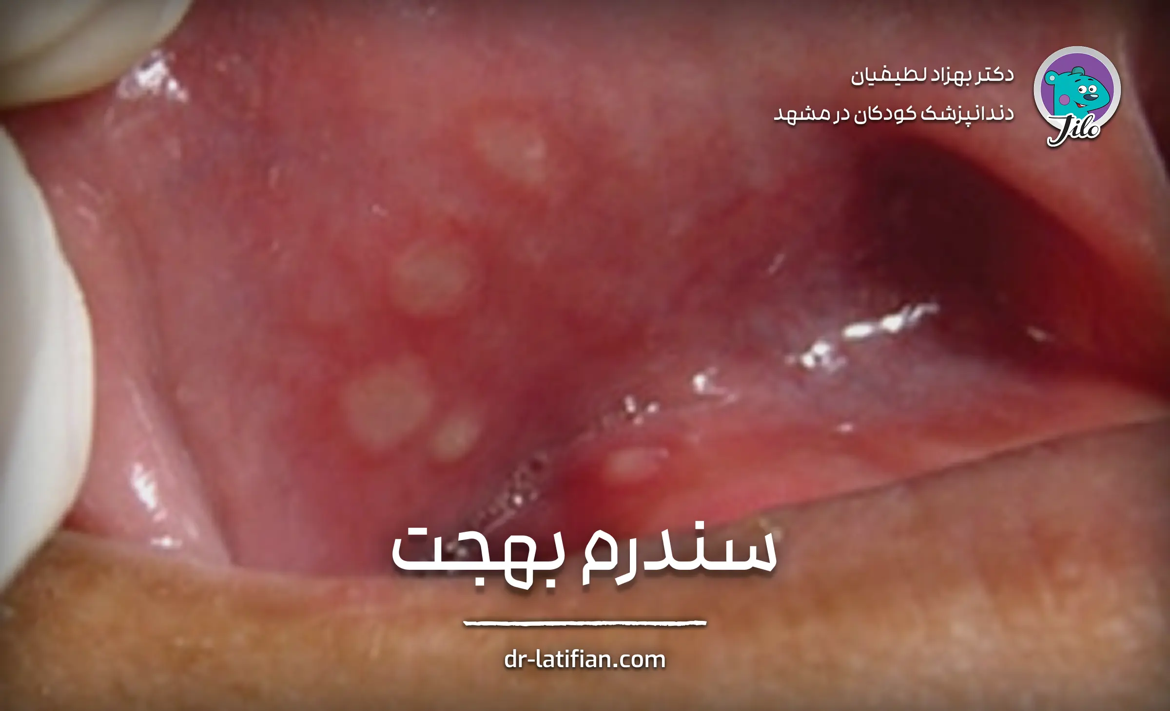 سندرم بهجت