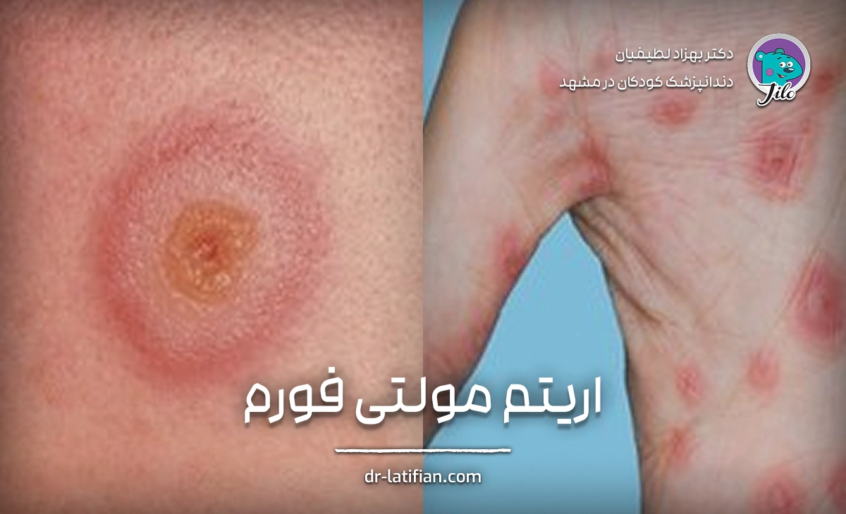 Erythema Multiforme