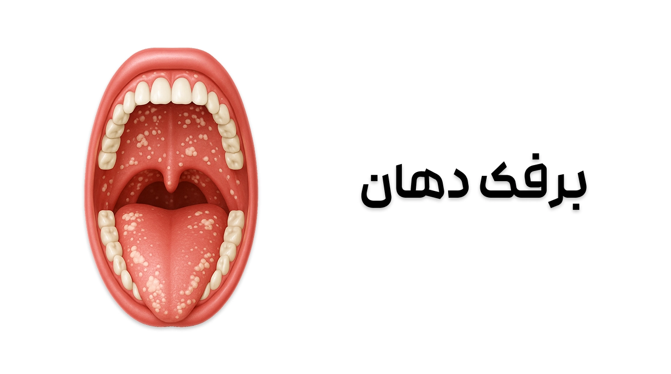 برفک دهان