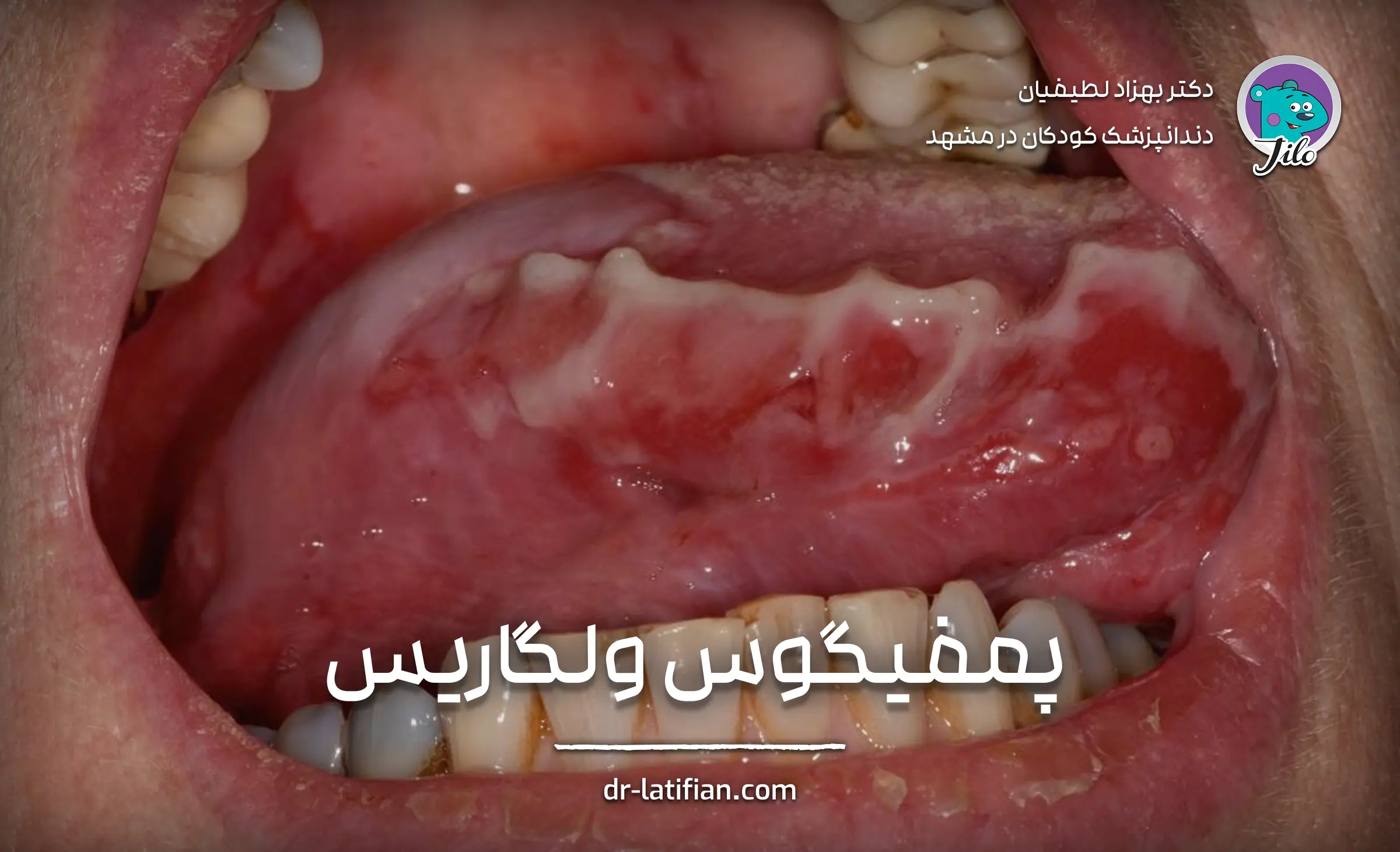 پمفیگوس ولگاریس یا پمفیگوس سیستمیک