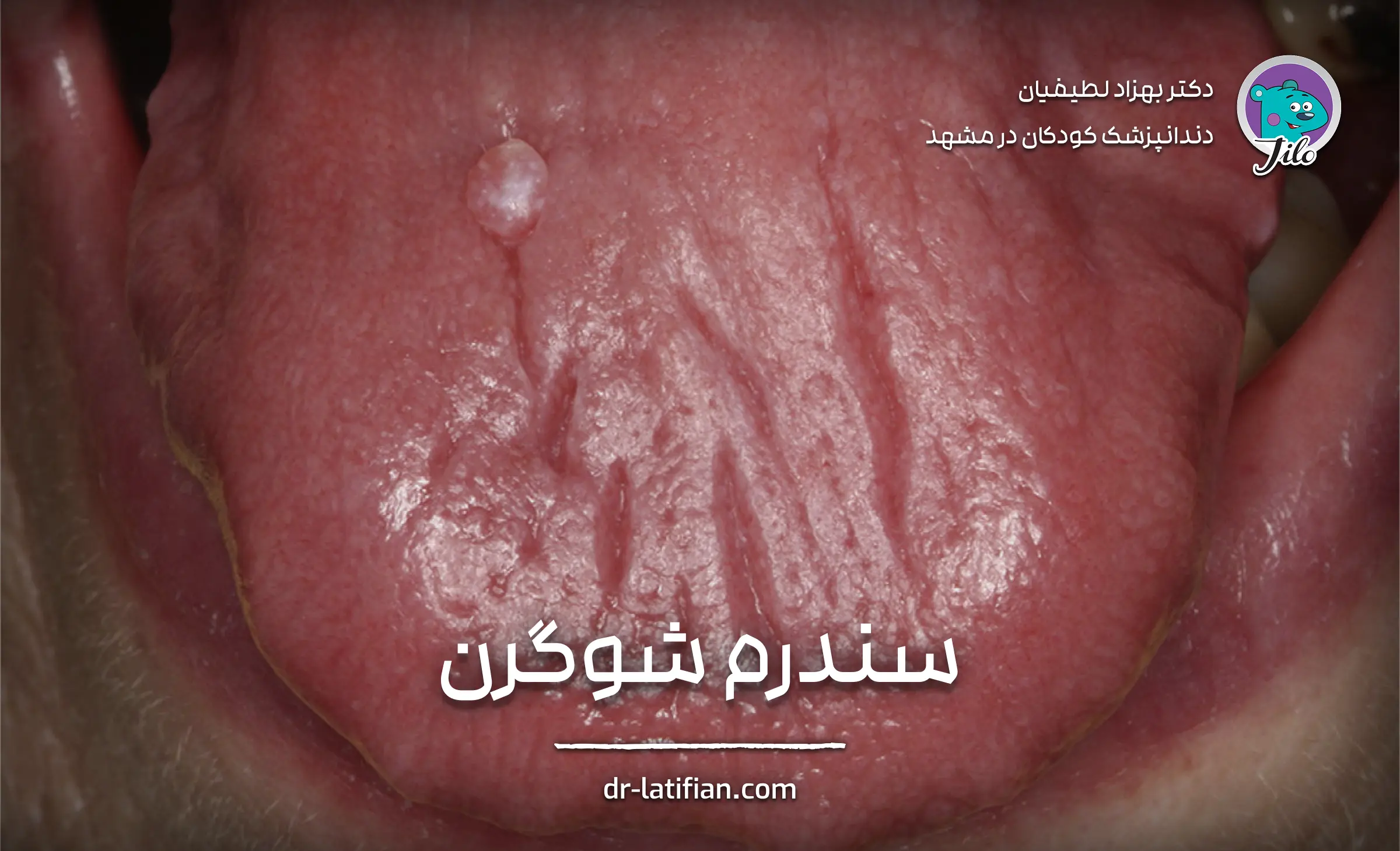 سندرم شوگرن