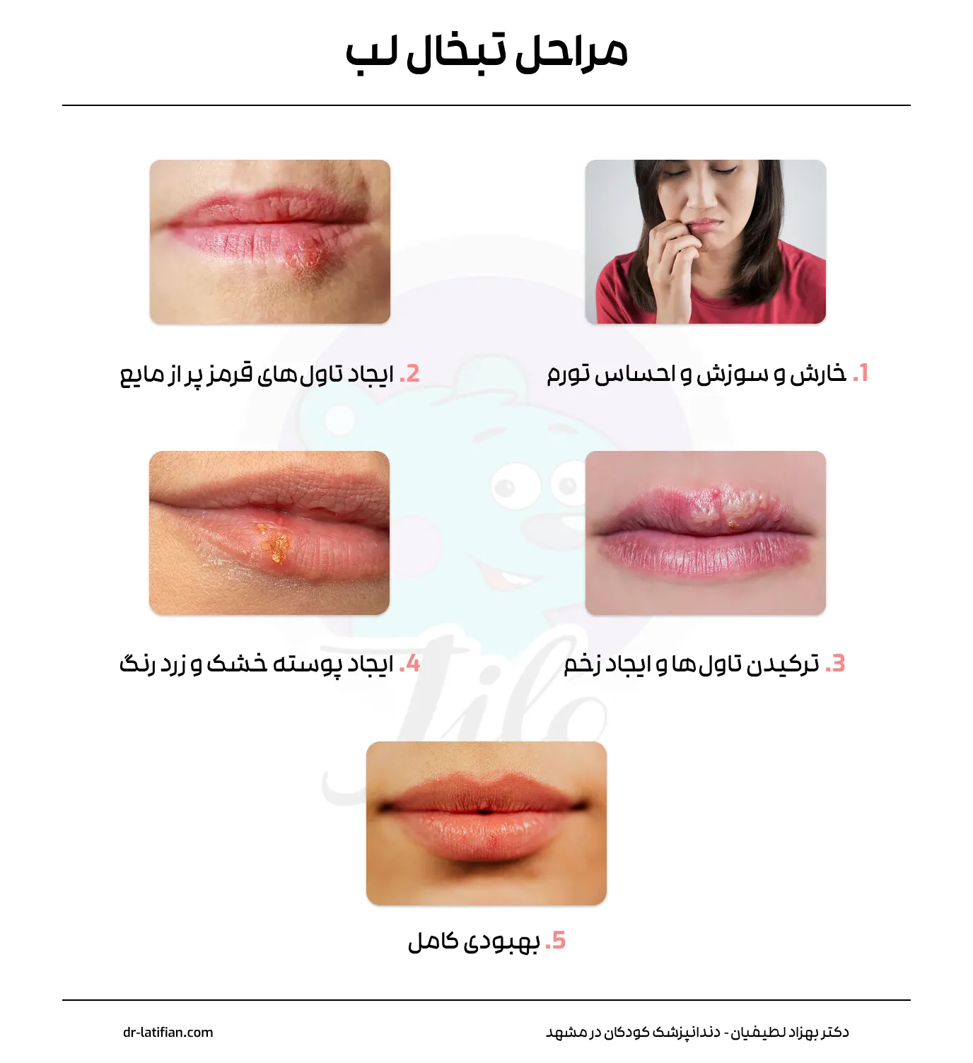 مراحل تبخال لب