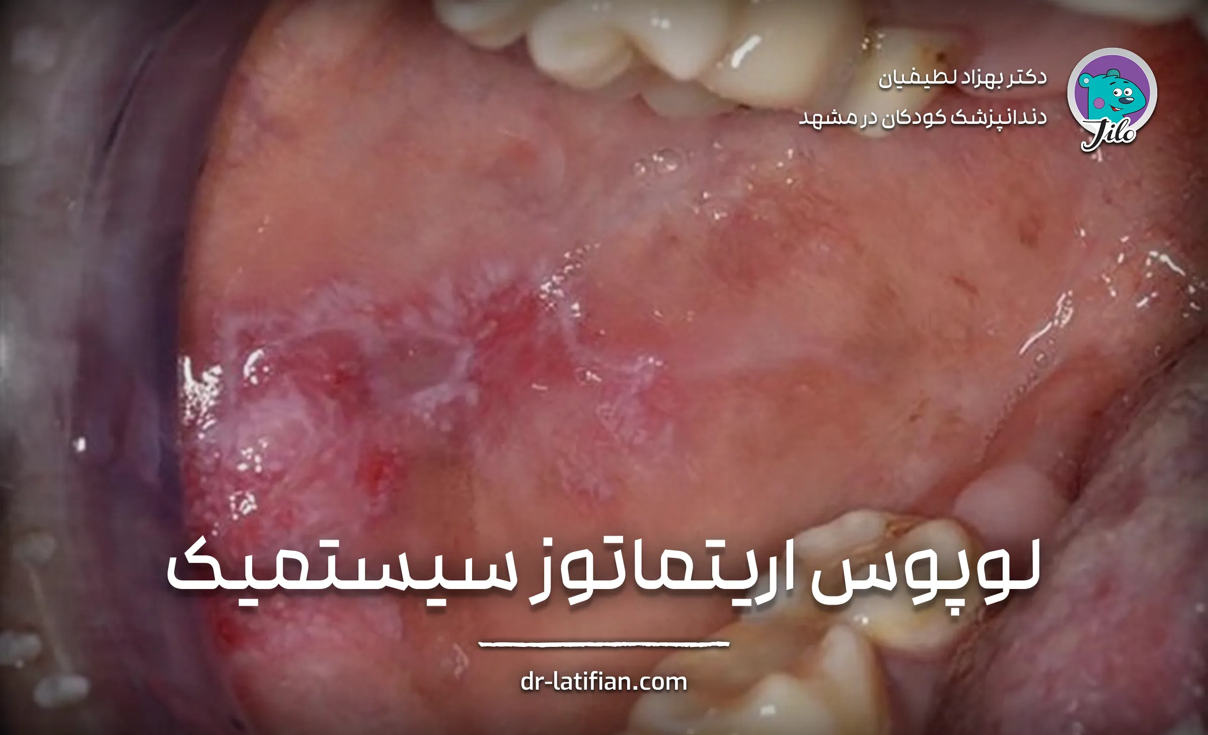 لوپوس اریتماتوز سیستمیک