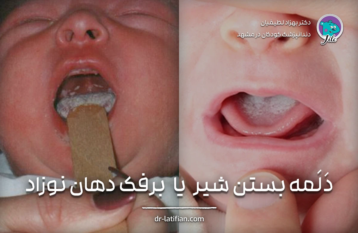 فرق برفک دهان نوزاد با دلمه شیر