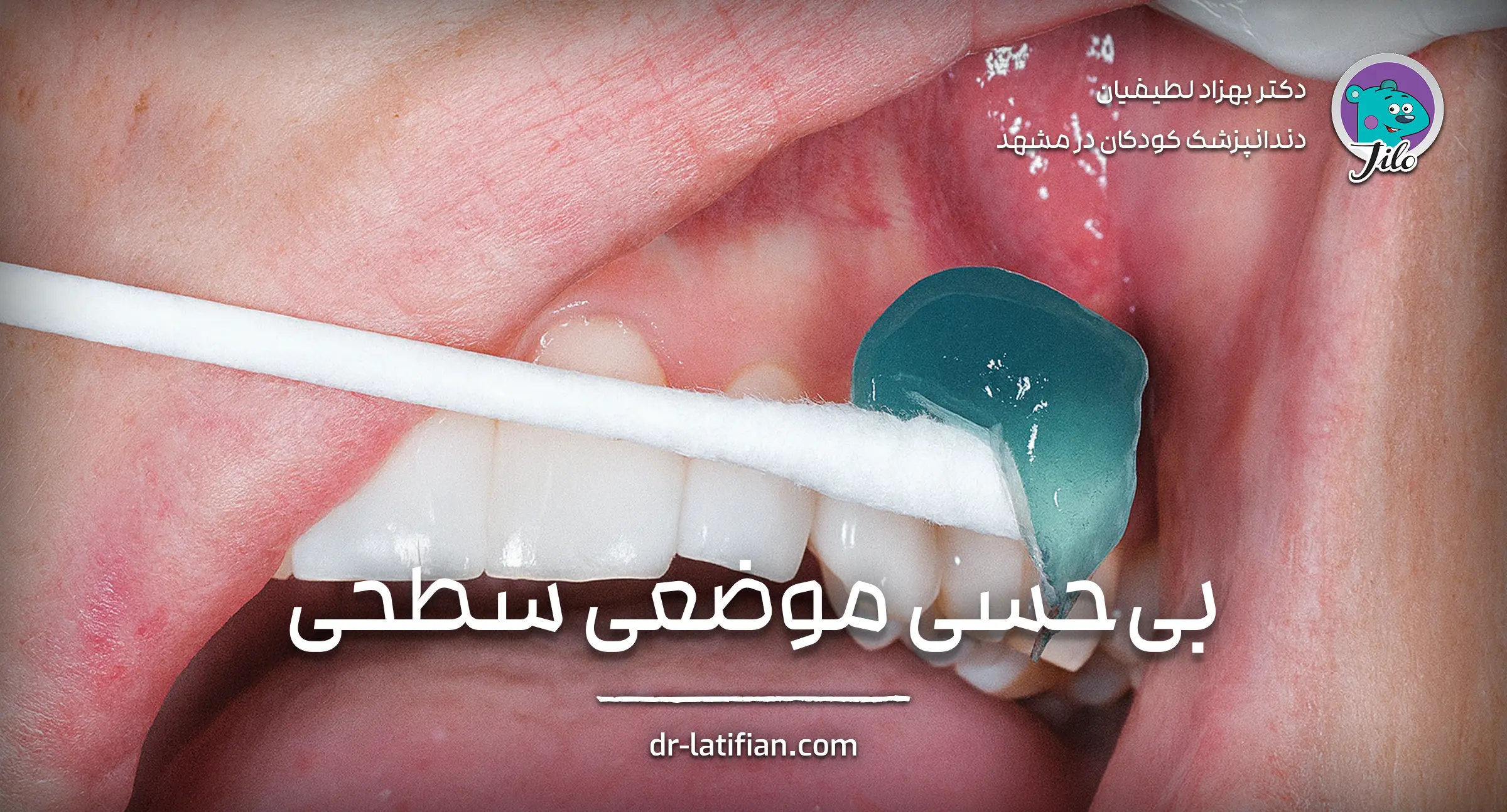 بی‌حسی موضعی سطحی با ژل لیدوکائین و بنزوکائین در دندانپزشکی کودکان