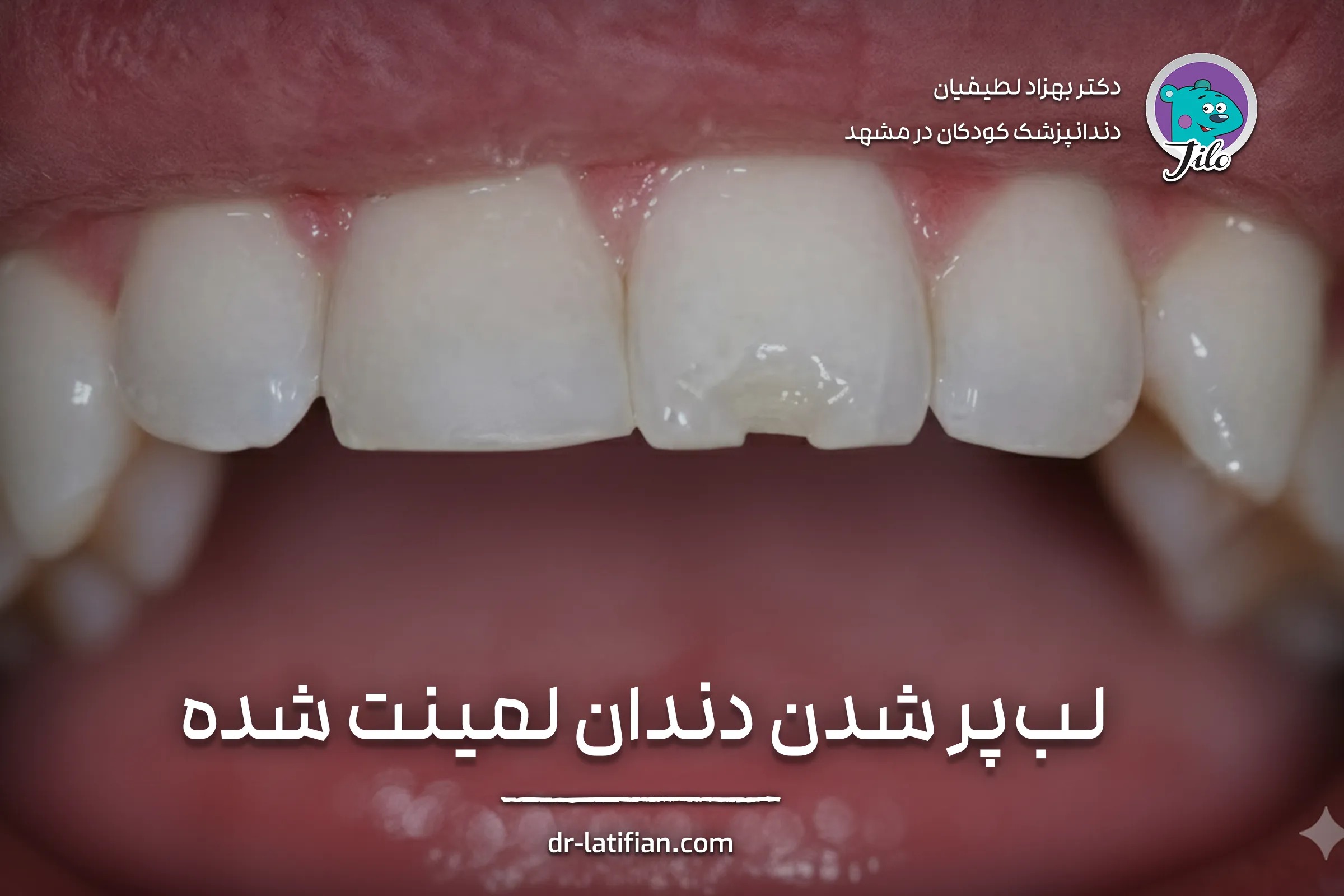 لب‌پر شدن یا شکستگی لمینت دندان
