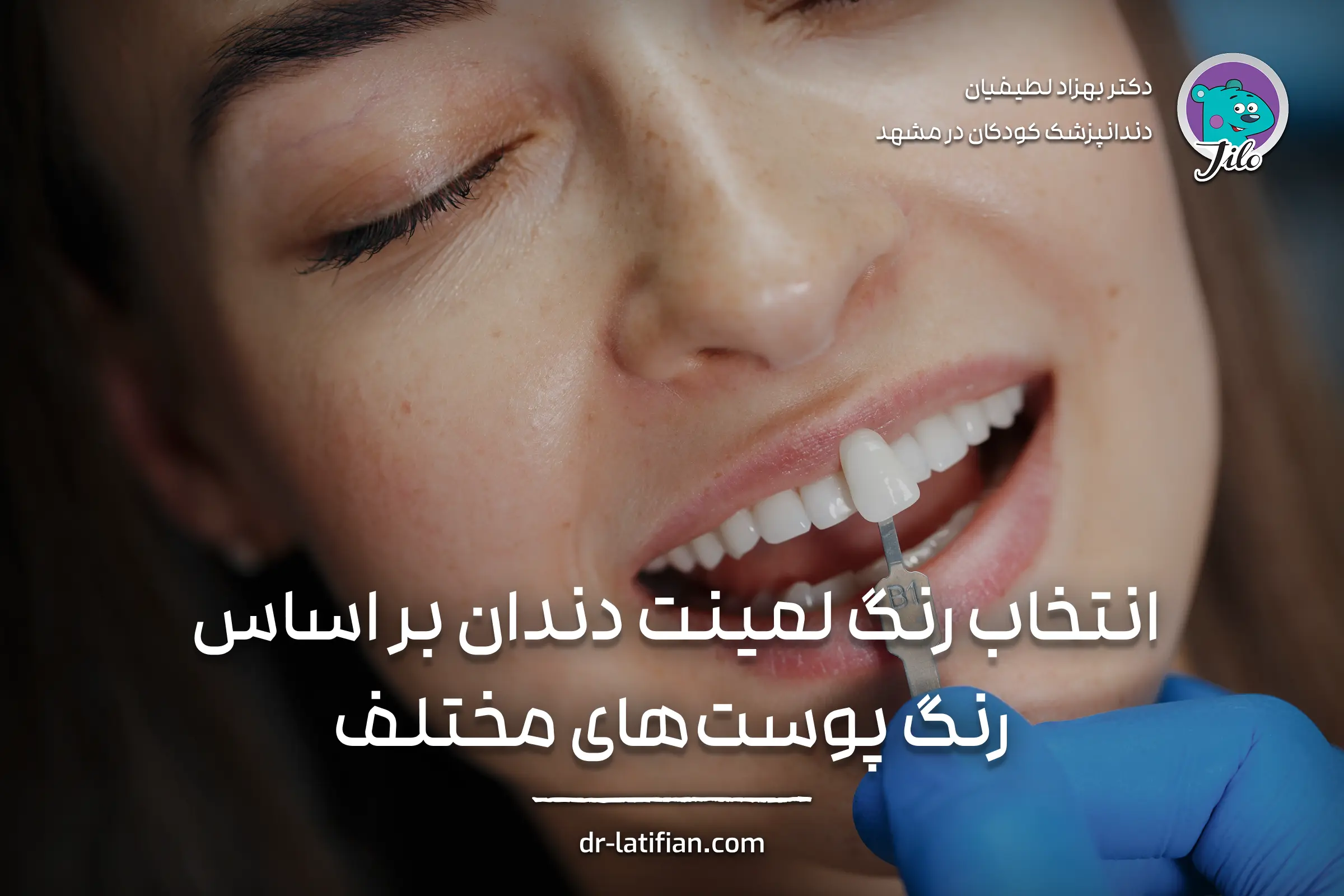 انتخاب رنگ لمینت دندان بر اساس رنگ پوست‌های روشن، گندمی، تیره و خیلی تیره برای داشتن لبخندی طبیعی و هماهنگ