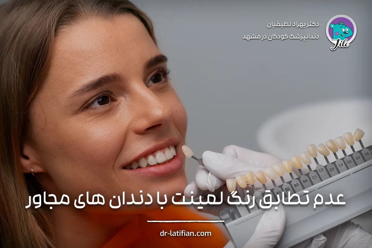 عدم تطابق رنگ لمینت دندان با دندان‌های مجاور به‌علت انتخاب اشتباه شید یا تست در نور غیرطبیعی؛ تصویر نشان‌دهنده تفاوت رنگی بین دندان‌ها است.