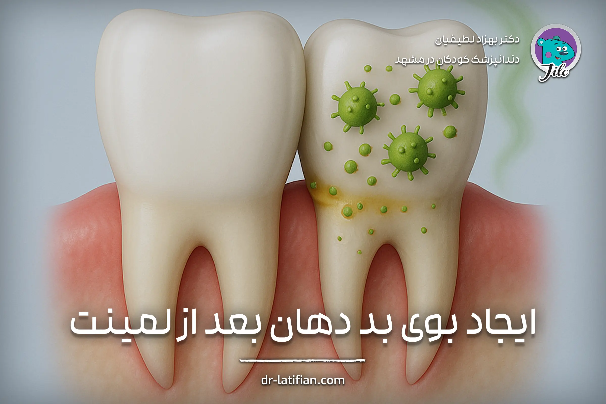 بوی بد دهان پس از لمینت دندان به‌علت تجمع باکتری و باقی‌ماندن مواد غذایی در زیر لمینت؛ تصویر نشان‌دهنده علت بوی دهان بعد از لمینت است.