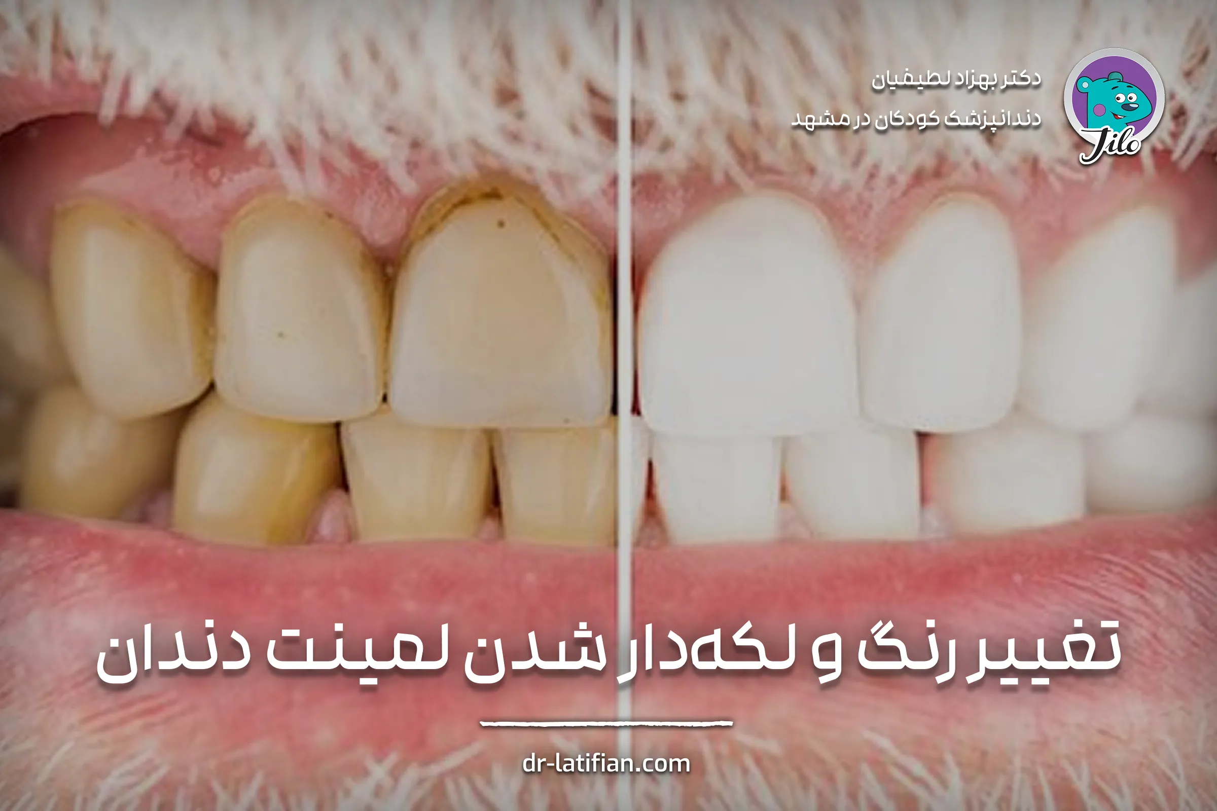 تغییر رنگ و لکه‌دار شدن لمینت دندان در اثر مصرف مکرر قهوه، چای یا سیگار؛ تصویر نشان‌دهنده لکه‌های سطحی روی لمینت است.