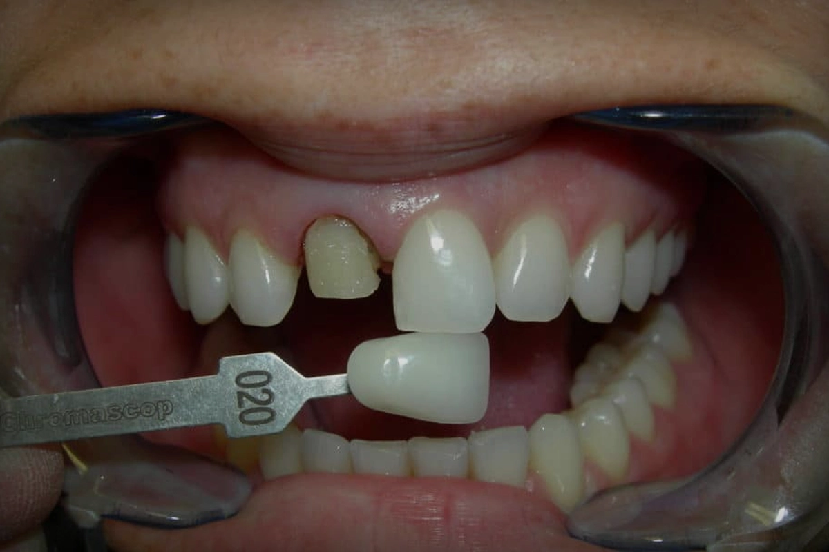 شکستگی یا افتادن لمینت دندان و راه‌های ترمیم و تعویض آن برای بازگرداندن لبخند طبیعی