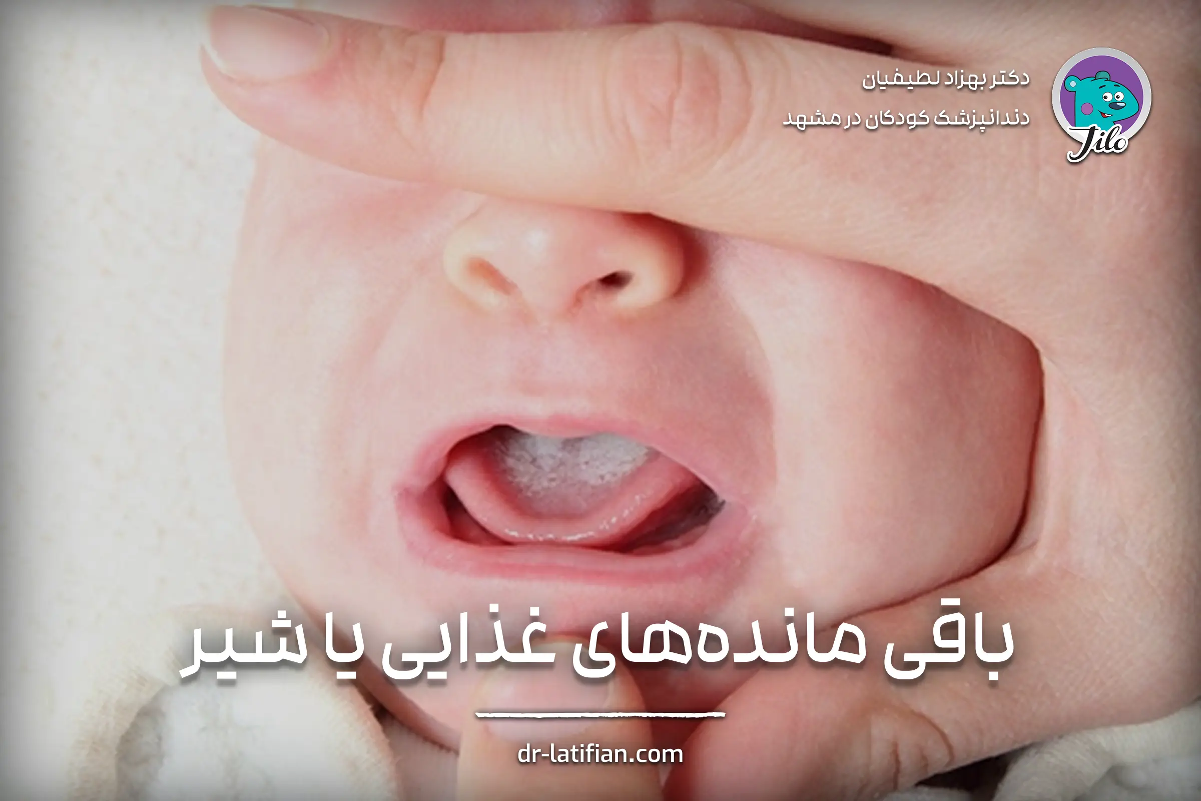 لکه سفید روی لثه نوزاد به‌دلیل باقی‌مانده شیر یا غذای خشک‌شده