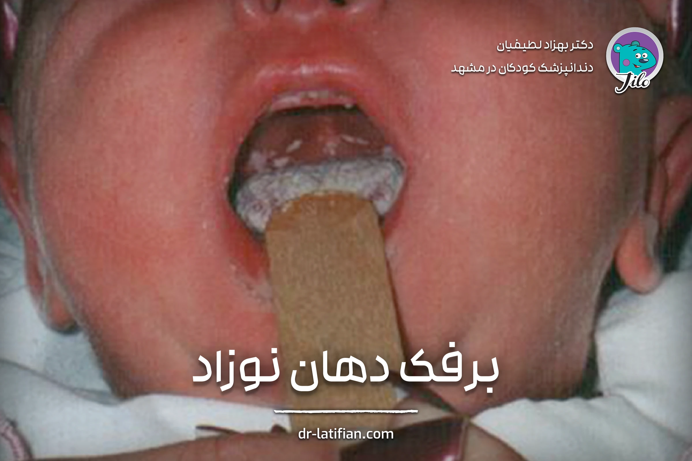برفک دهانی نوزاد؛ لکه سفید ناشی از قارچ کاندیدا روی لثه و زبان