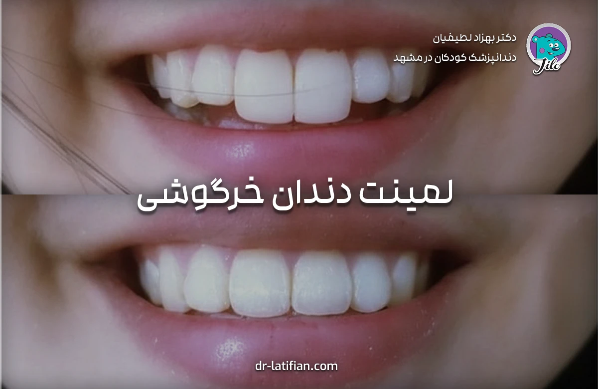 لمینت دندان خرگوشی برای اصلاح بیرون‌زدگی دندان‌ها یا ایجاد لبخند خاص و جذاب