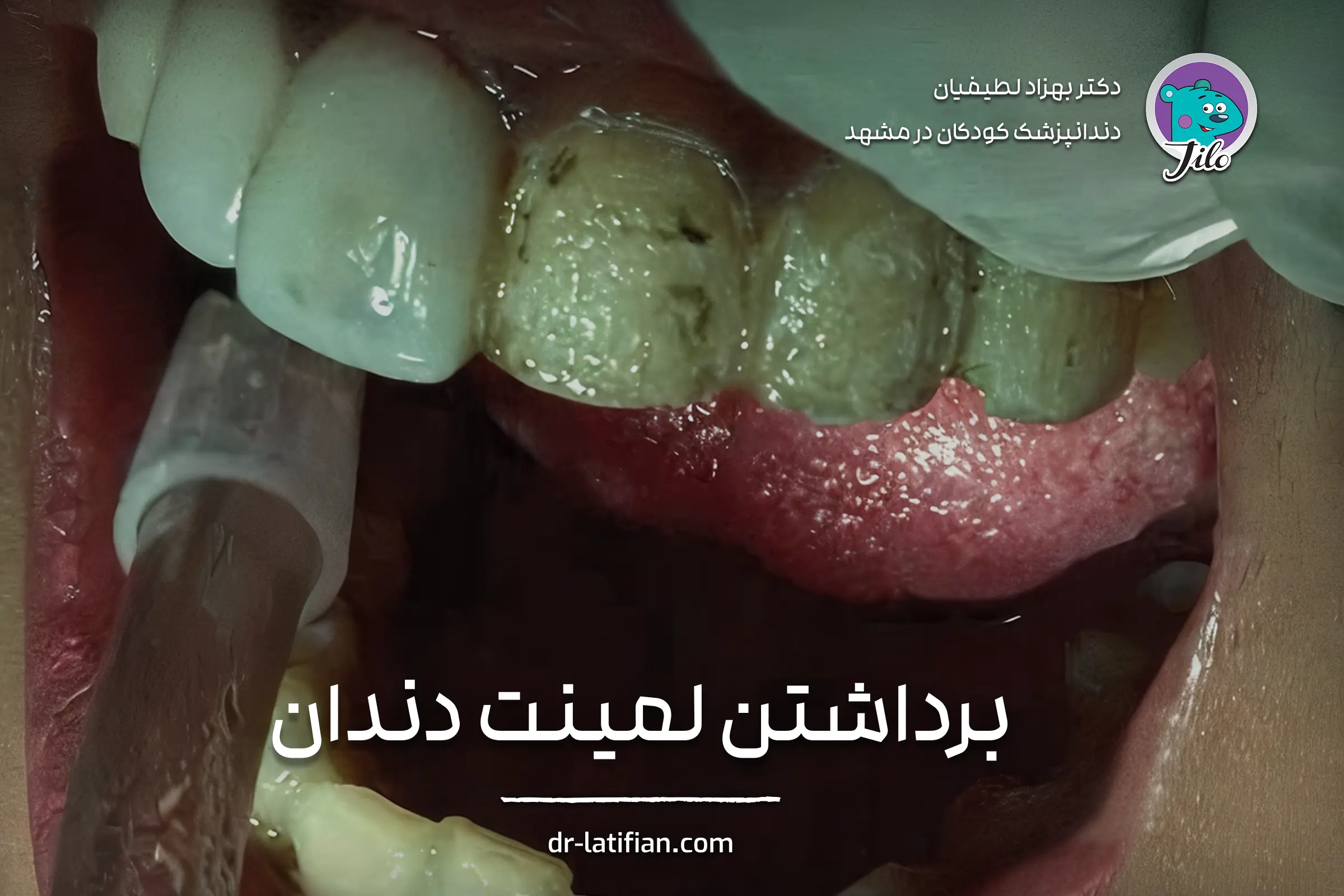 برداشتن لمینت دندان به‌دلیل شکستگی، تغییر رنگ یا پوسیدگی زیر روکش