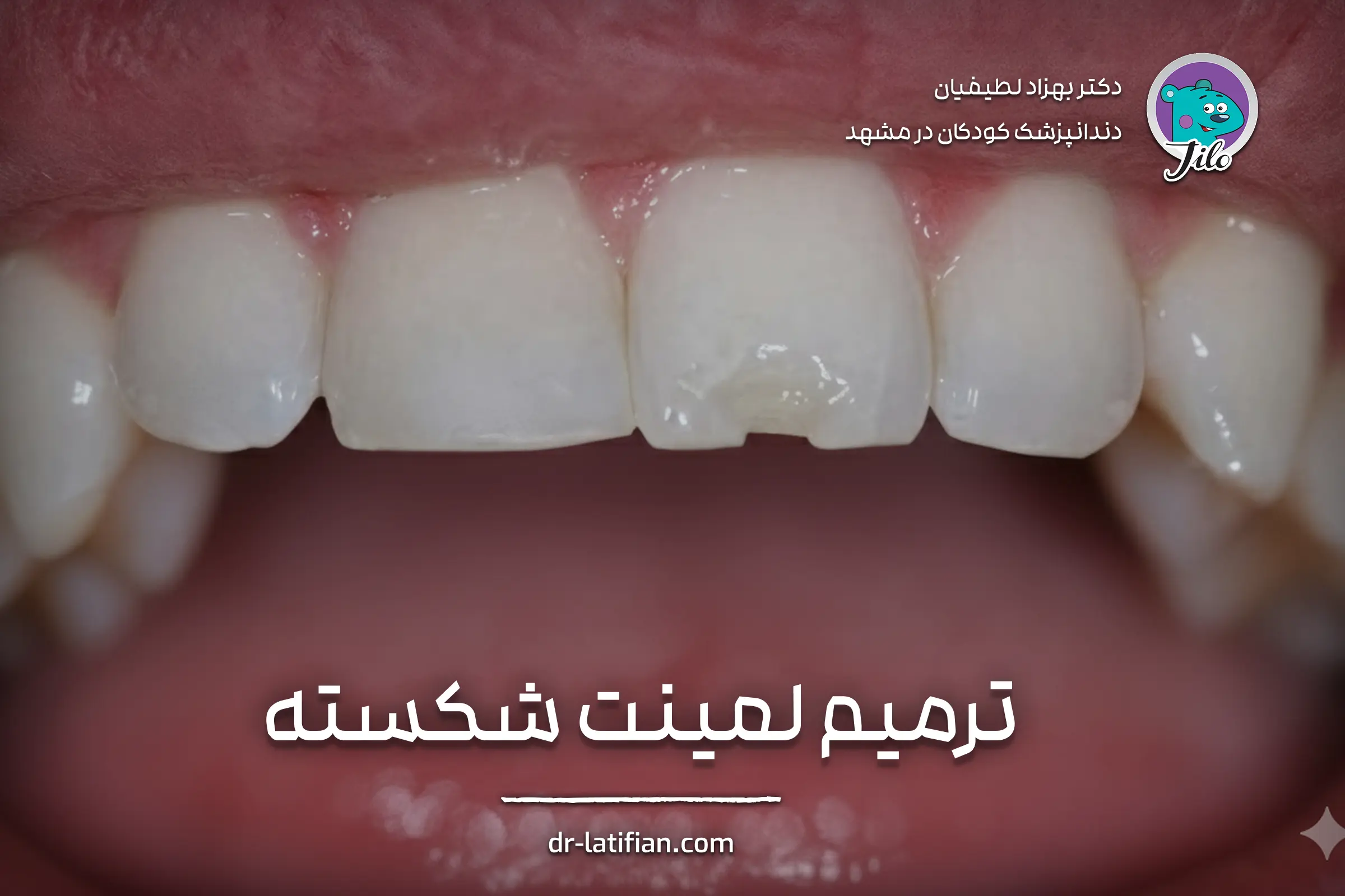 ترمیم لمینت دندان شکسته یا لب‌پریده توسط دندانپزشک متخصص