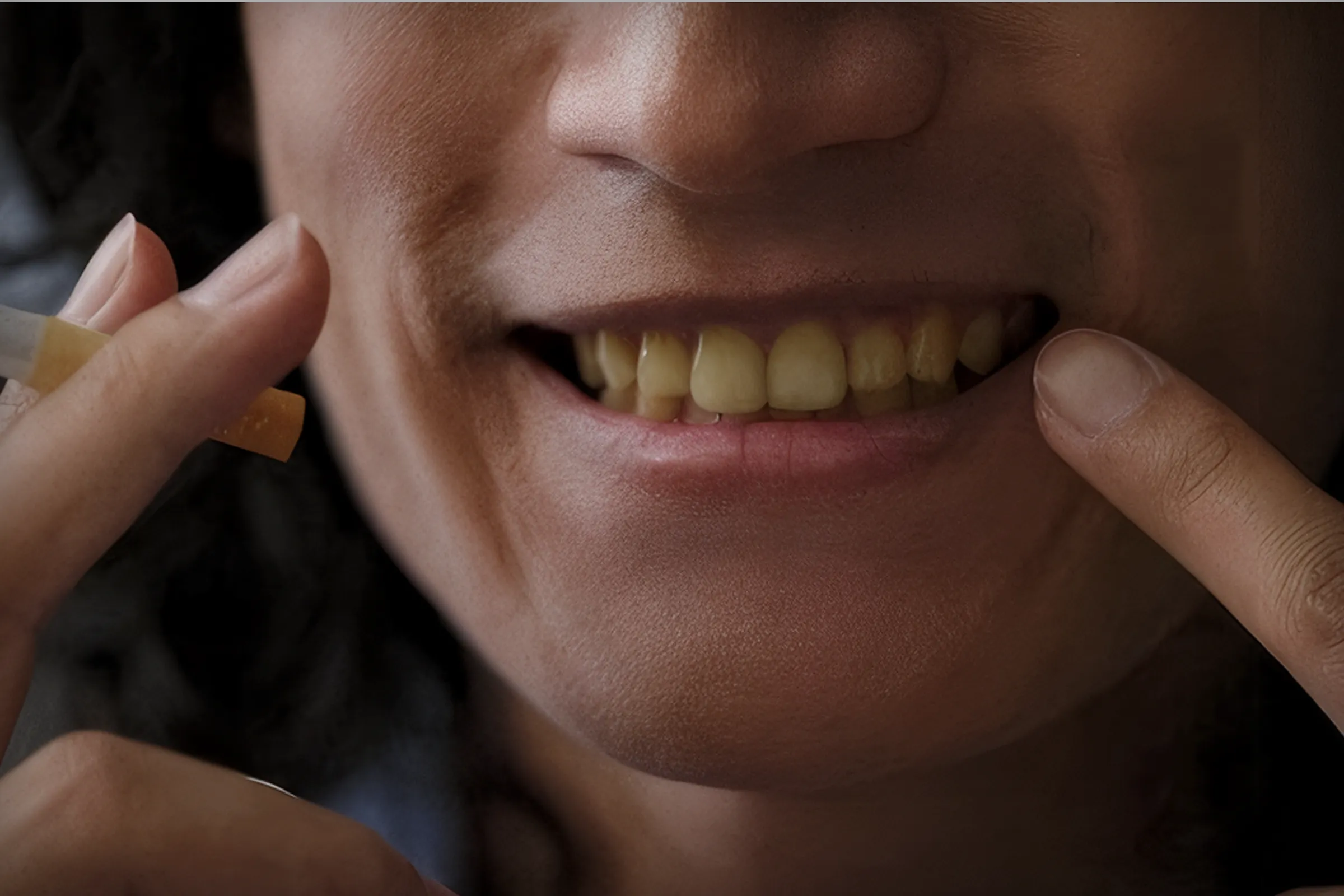 تأثیر سیگار، قلیان و ویپ بر دوام و رنگ لمینت دندان و سلامت لثه‌ها