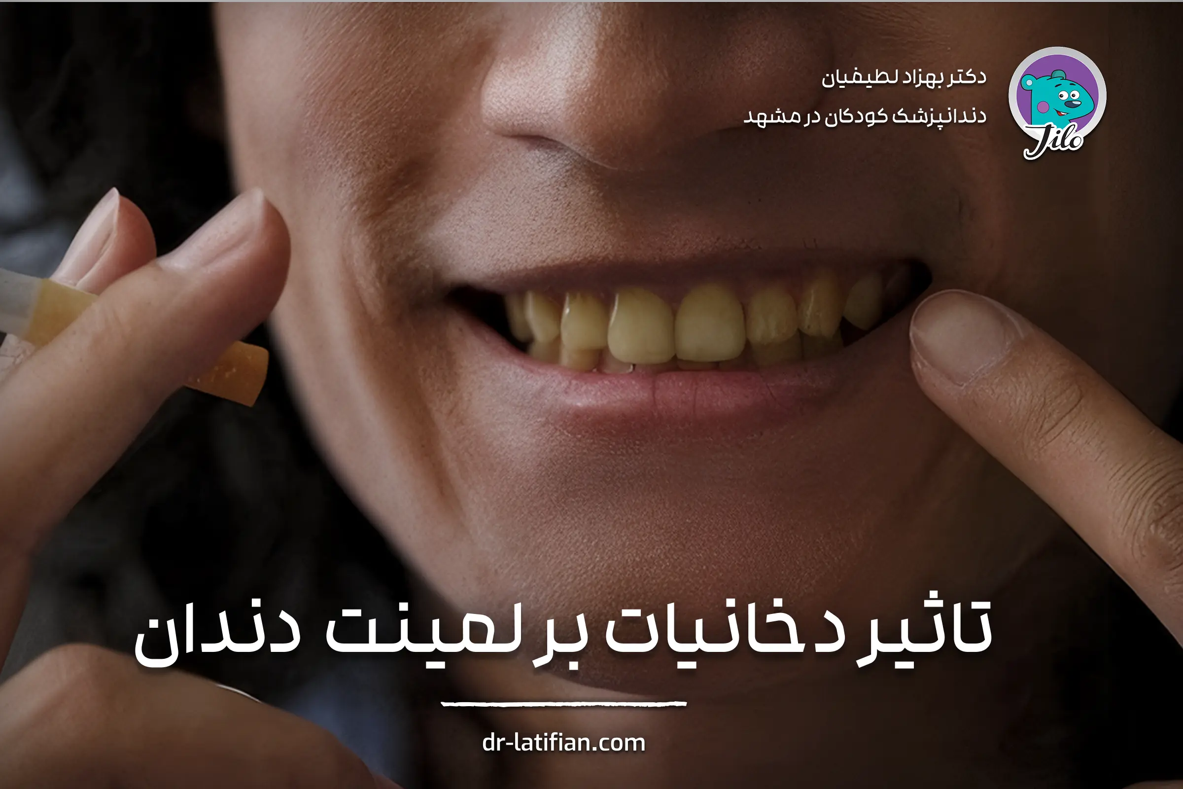 تأثیر سیگار و قلیان بر تغییر رنگ و دوام لمینت دندان