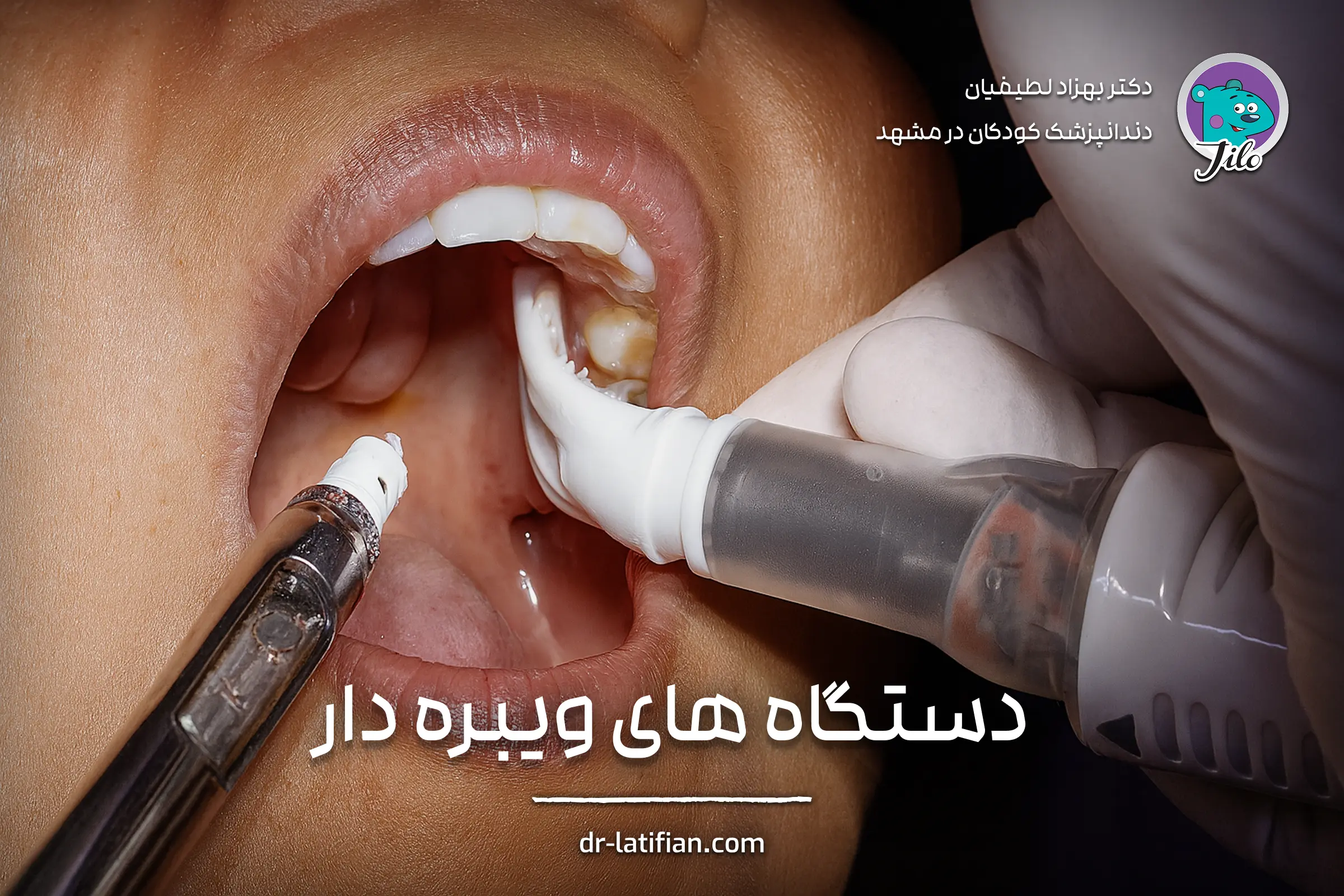 دستگاه ویبره DentalVibe برای کاهش درد تزریق در دندانپزشکی کودکان