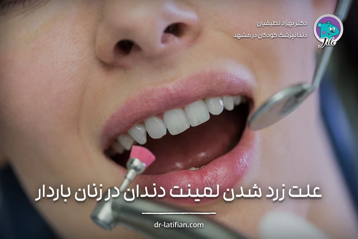 آیا لمینت دندان تغییر رنگ‌داده قابل سفید شدن است؛ روش‌های جرم‌گیری و پولیش حرفه‌ای برای ترمیم درخشندگی