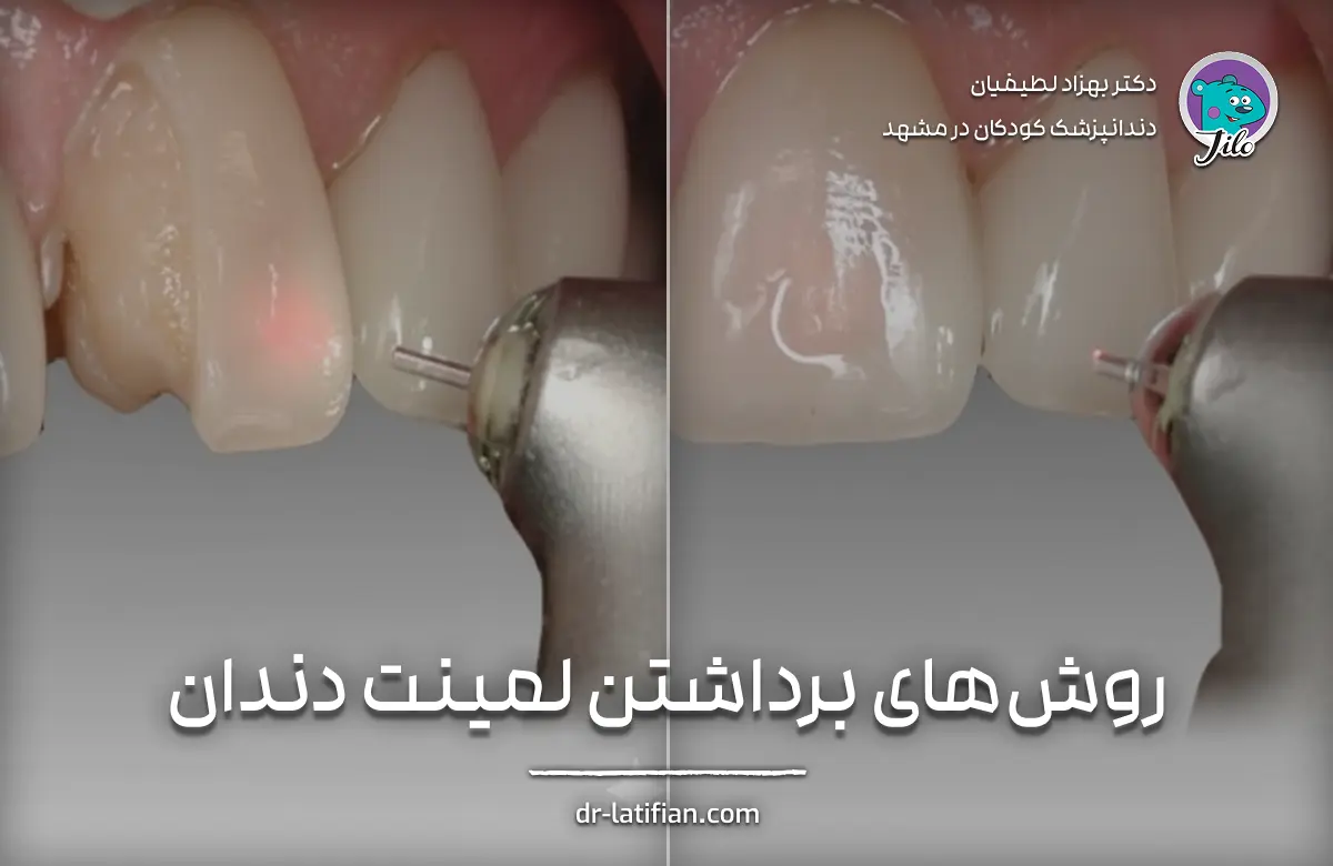 روش‌های برداشتن لمینت دندان با استفاده از ابزارهای خاص و لیزر توسط دندانپزشک متخصص