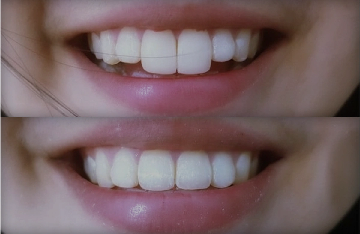 لمینت دندان خرگوشی؛ روش‌های اصلاح برجستگی دندان‌های جلو و زیباسازی طرح لبخند