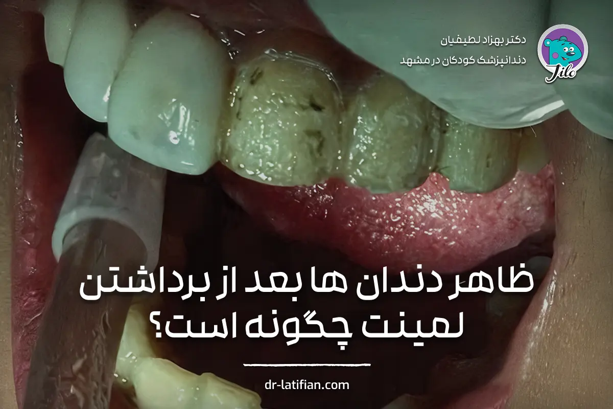 ظاهر دندان‌ها بعد از برداشتن لمینت؛ بررسی تغییر رنگ، زبری سطح و حساسیت دندان‌ها