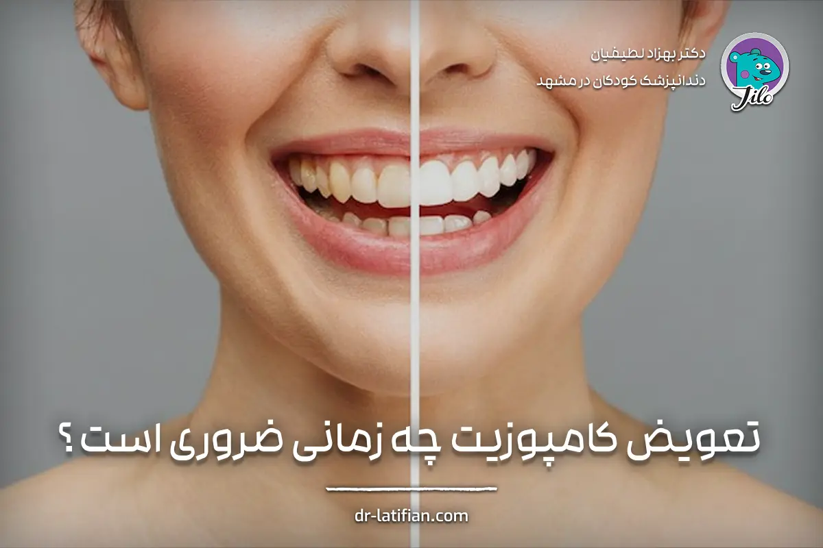 تعویض کامپوزیت دندان؛ زمان مناسب برای تعویض و مراحل بازسازی لبخند