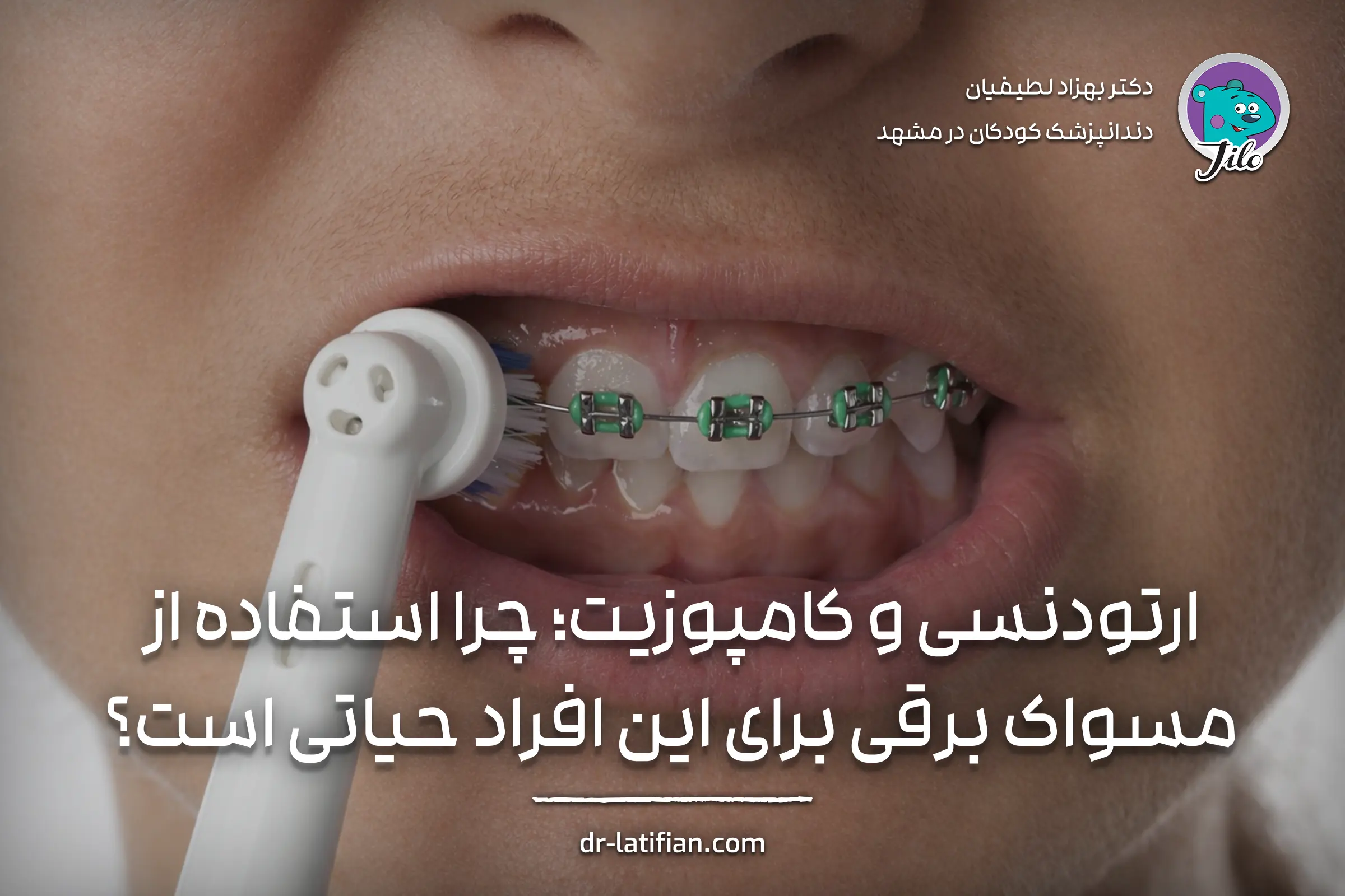 مسواک برقی مناسب ارتودنسی و کامپوزیت برای پاکسازی دقیق اطراف براکت‌ها و محافظت از لثه