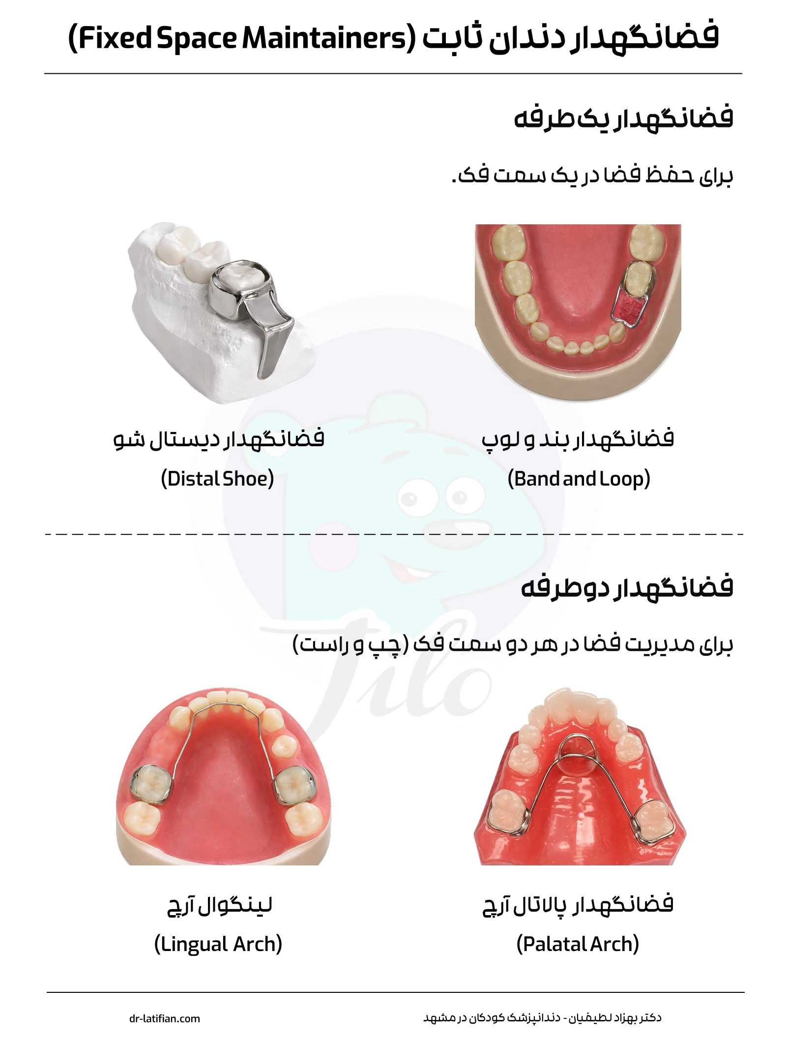 انواع فضانگهدار دندان ثابت شامل بند و لوپ، دیستال شو، پالاتال آرچ و لینگوال آرچ در فک بالا و پایین