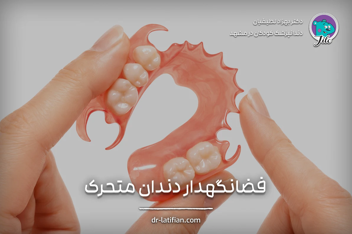 فضانگهدار دندان متحرک کودک ساخته شده از آکریلیک برای حفظ فضای چند دندان از دست رفته