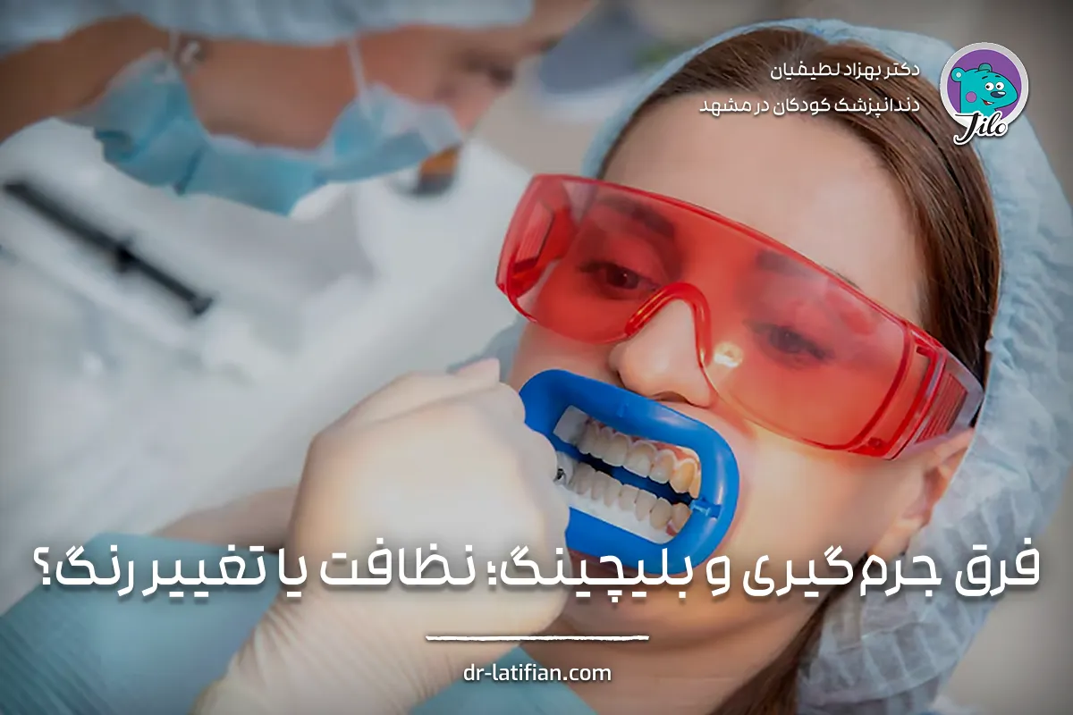 مقایسه جرم‌گیری و بلیچینگ دندان؛ تفاوت نظافت درمانی با سفید کردن زیبایی دندان‌ها