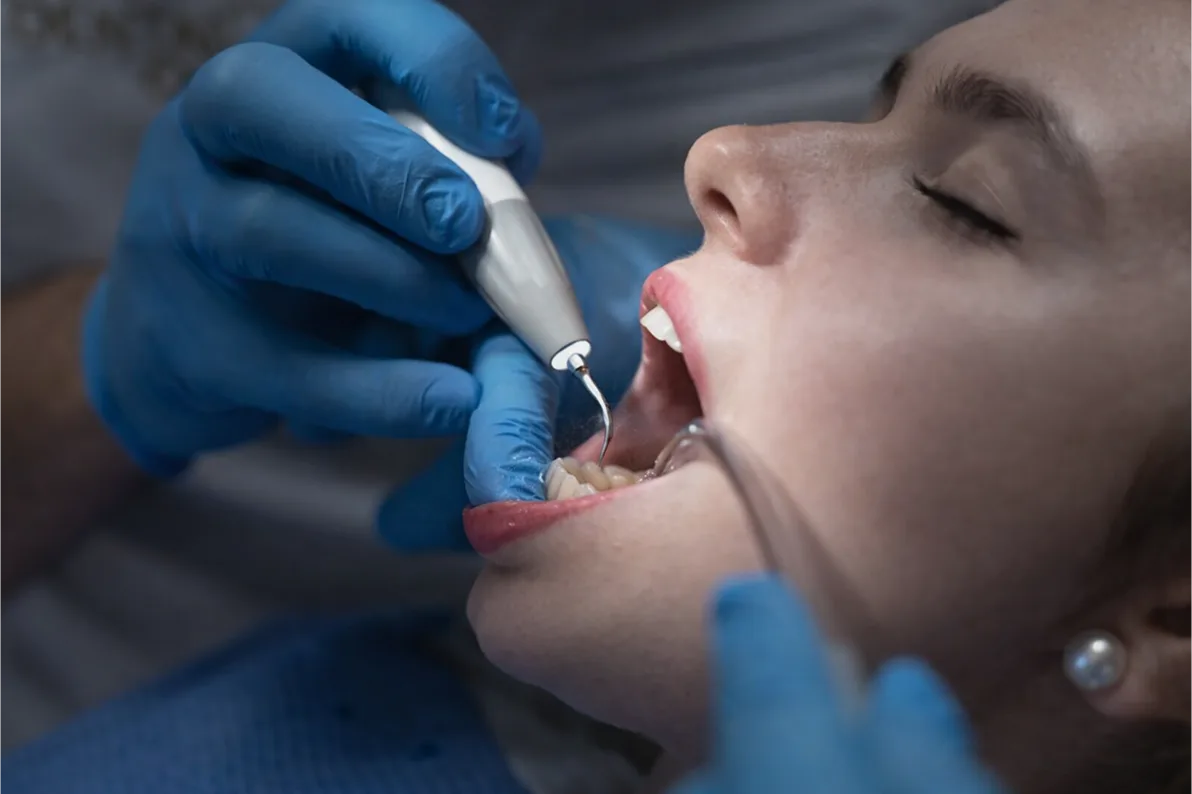 جرمگیری دندان توسط دندانپزشک برای حذف پلاک و جرم‌های سخت و جلوگیری از بیماری لثه