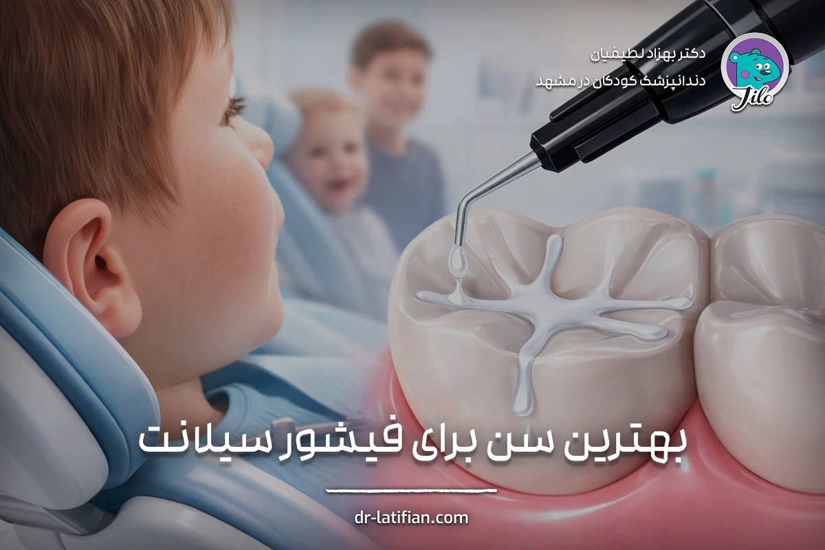 انجام فیشور سیلانت روی دندان آسیاب کودک در سن مناسب برای پیشگیری از پوسیدگی