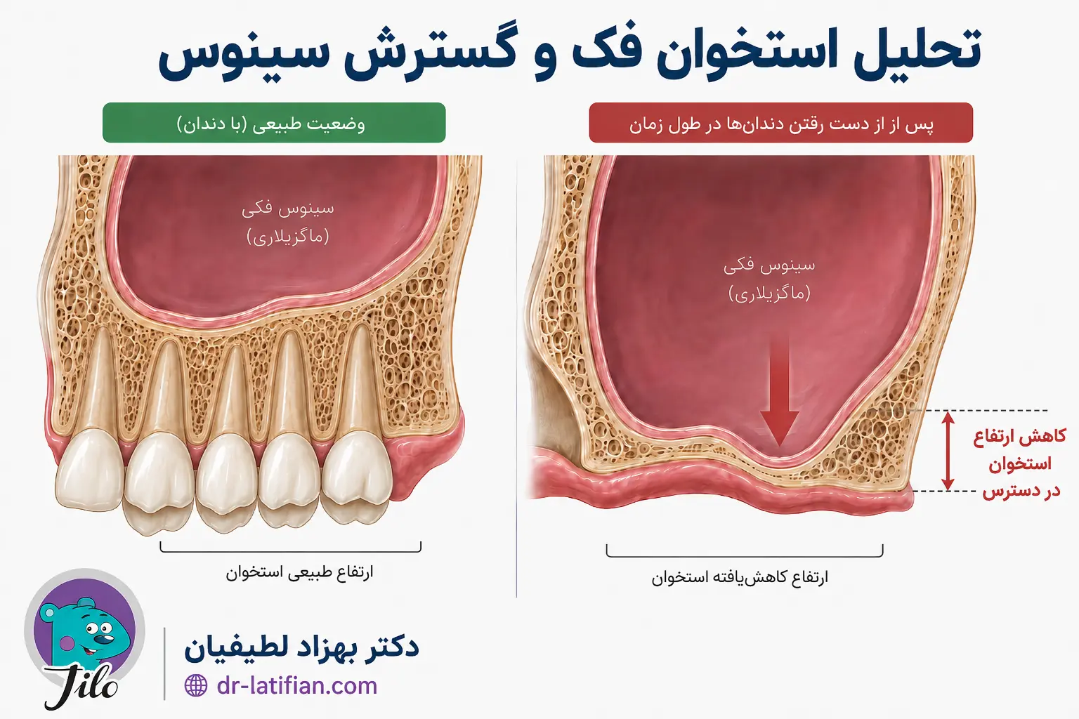توضیح سینوس لیفت و نقش سینوس ماگزیلاری در کاهش استخوان فک بالا