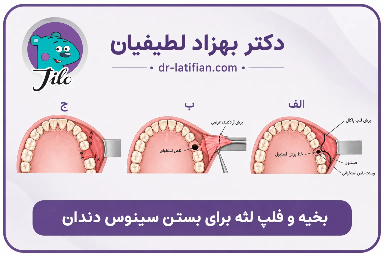 بخیه و فلپ لثه برای بستن سینوس دندان و ارتباط دهانی سینوسی