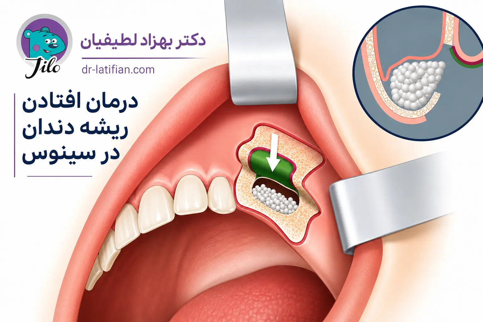 درمان افتادن ریشه دندان در سینوس و بستن سوراخ سینوس دندان