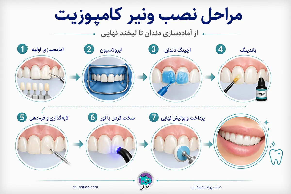 اینفوگرافیک مراحل نصب ونیر کامپوزیت از آماده‌سازی تا پولیش نهایی