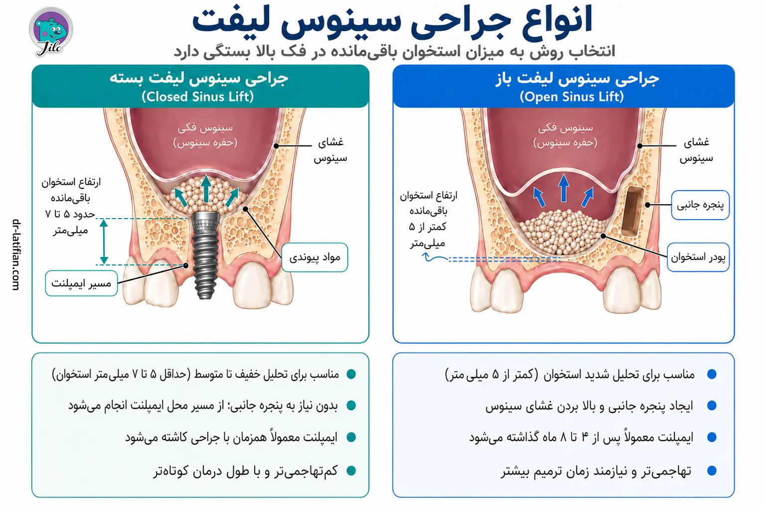 اینفوگرافیک مقایسه جراحی سینوس لیفت باز و بسته، شامل نحوه انجام، میزان استخوان باقی‌مانده و زمان کاشت ایمپلنت