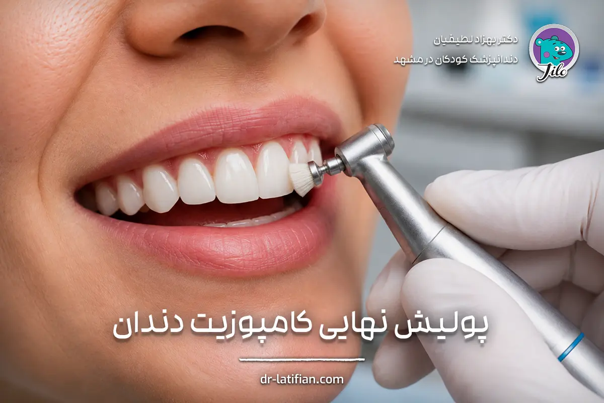 پولیش نهایی کامپوزیت دندان با ابزار دندانپزشکی برای ایجاد سطحی صاف و براق