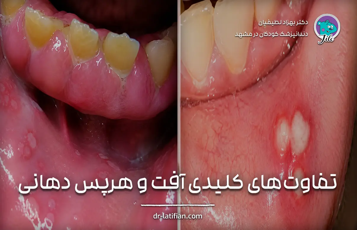 تفاوت آفت دهان و هرپس دهانی از نظر علت، محل بروز، واگیردار بودن و شکل ضایعات