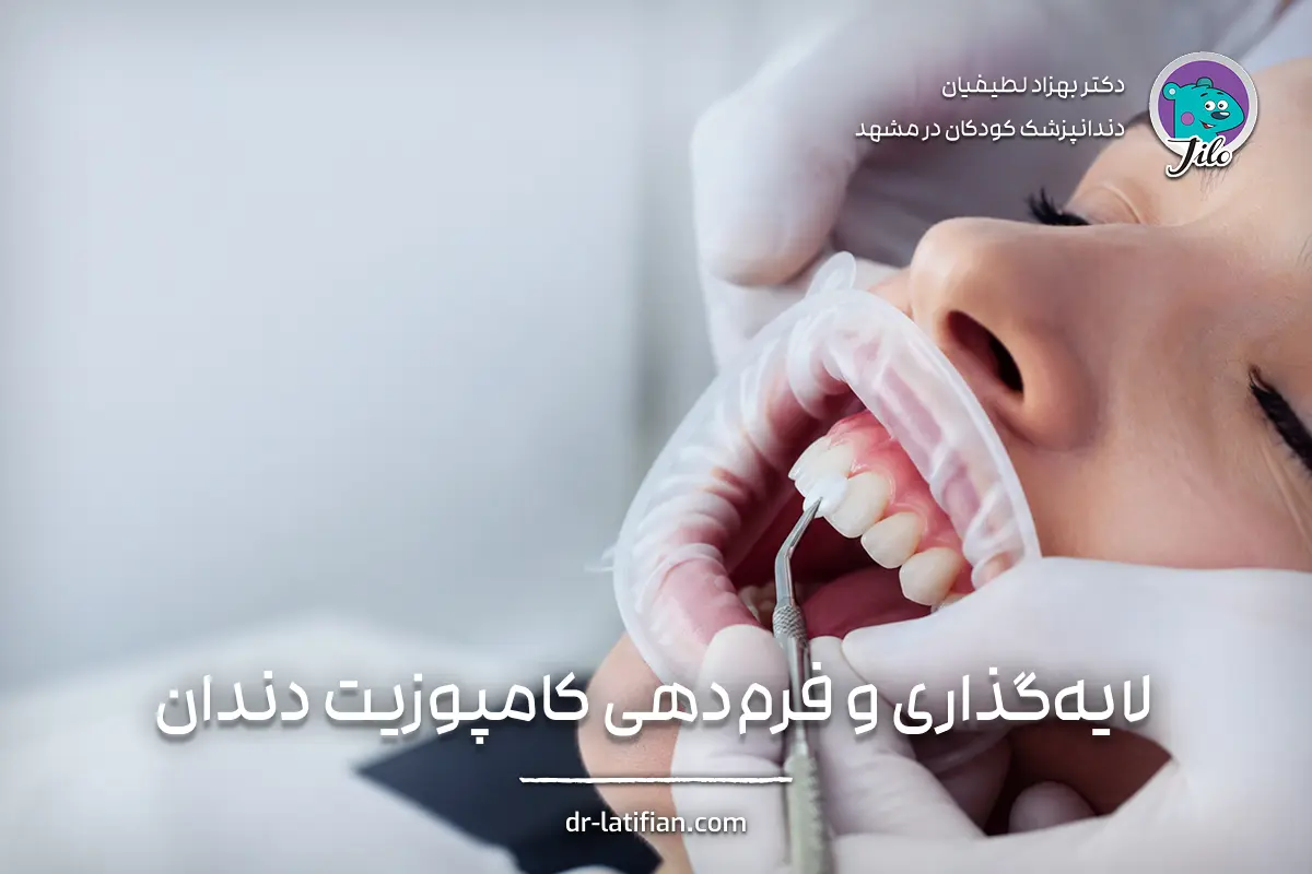 لایه‌گذاری و فرم‌دهی کامپوزیت دندان توسط دندانپزشک